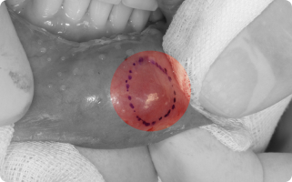 점액낭종, 하마종