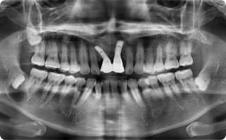 턱 뼈에 생긴 양성 종양