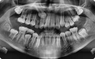 교정적 견인을 위한 개창술