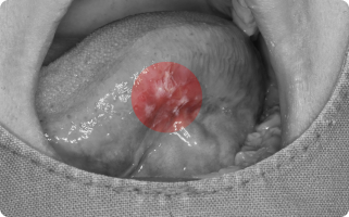 구강암과 전암병소