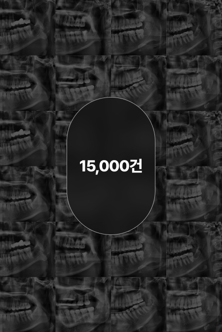1만 5천 건 이상의 사랑니 발치 경험
